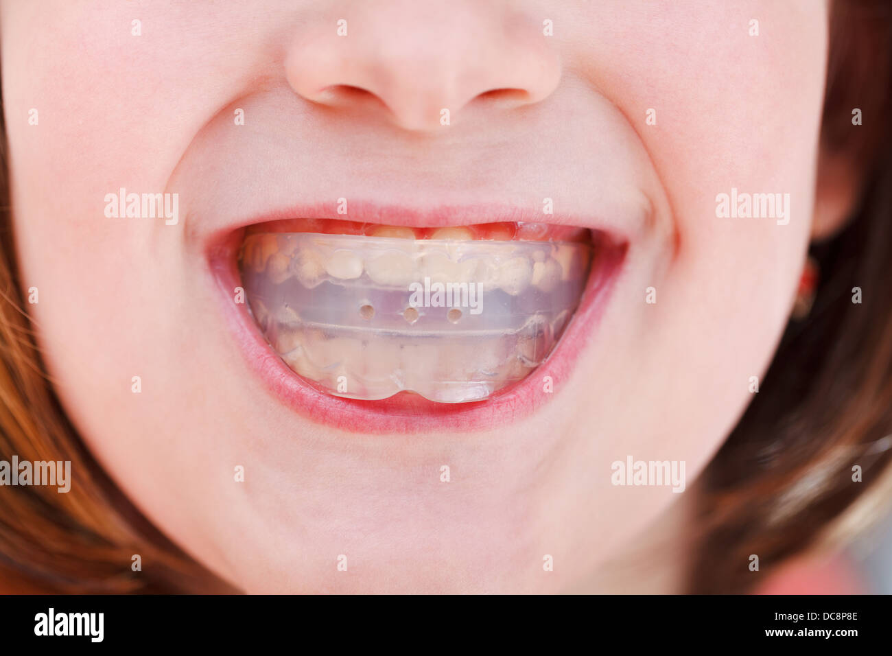 correction of children occlusion by pre-orthodontic trainer Stock Photo