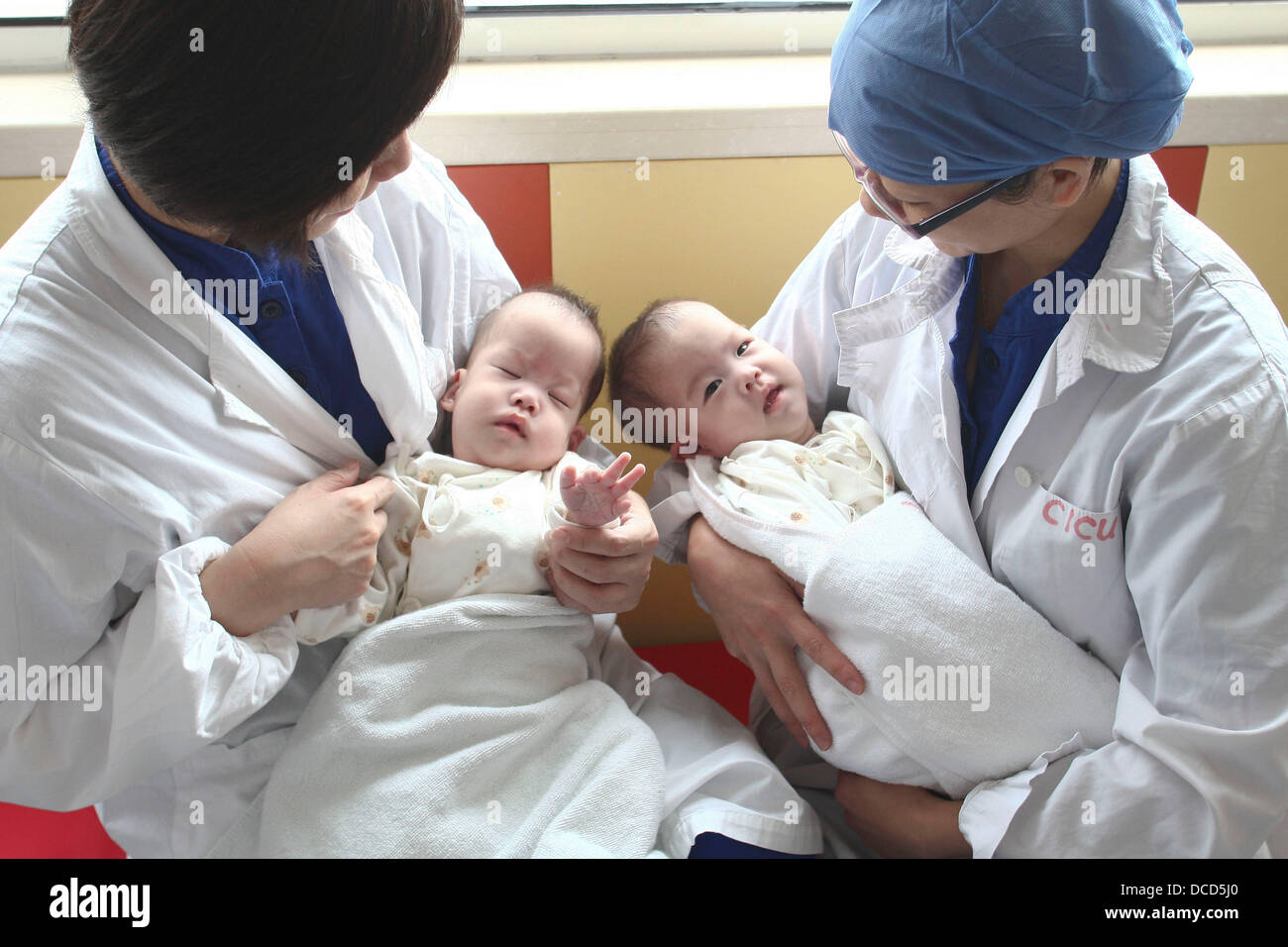 CONJOINED TWINS Four-month-old conjoined twin girls from Zhejiang were ...