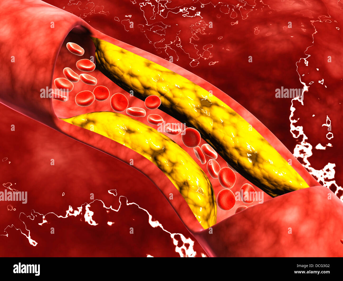 Microscopic view of fat plaque inside the artery. Stock Photo