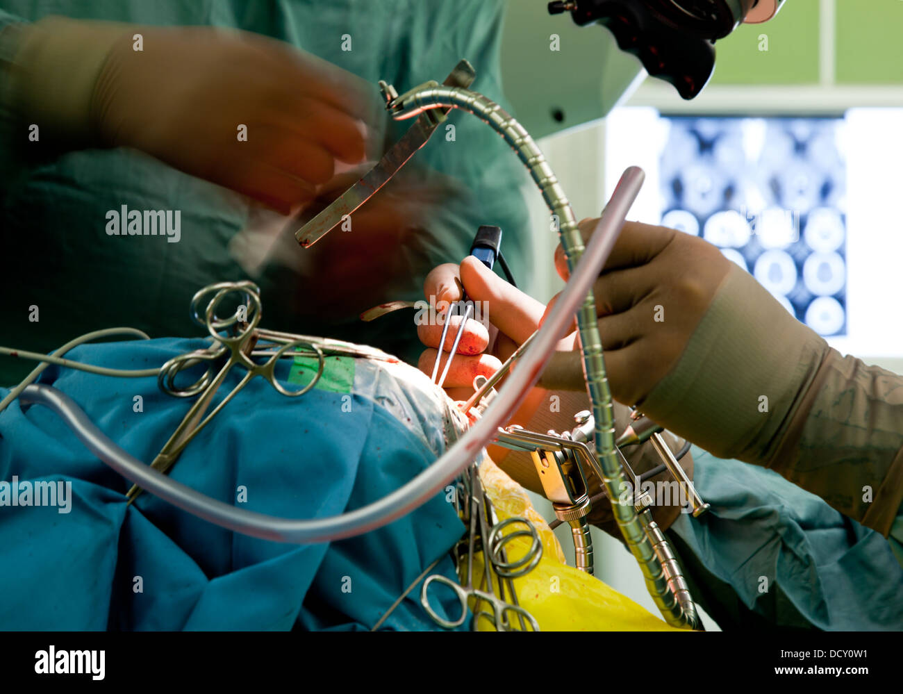 Brain Surgery High Resolution Stock Photography and Images Alamy