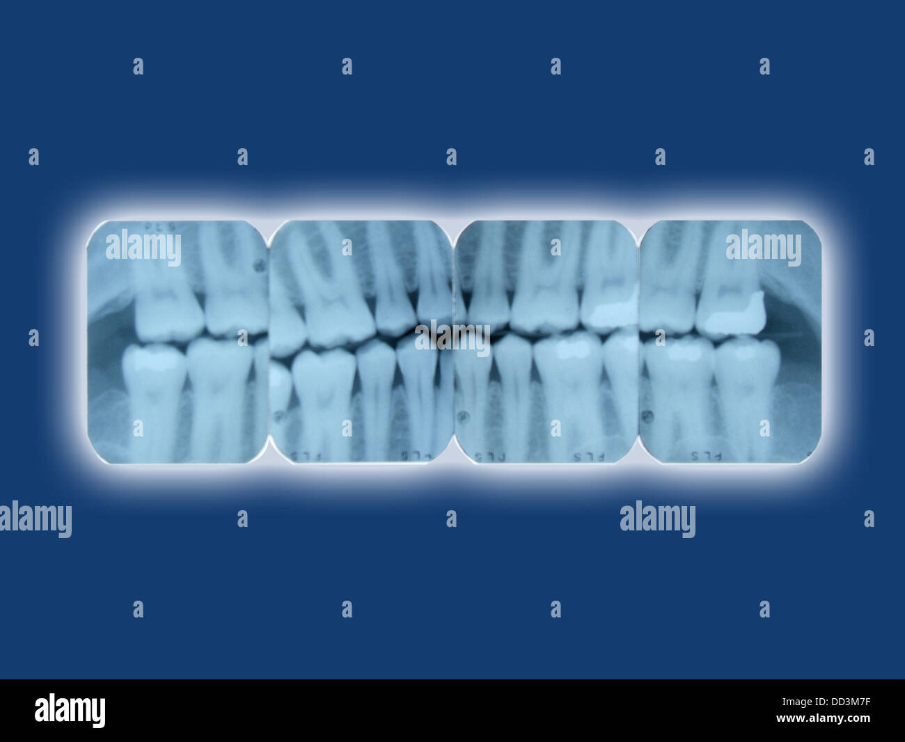 Dental x-ray sheets glowing on a blue background Stock Photo