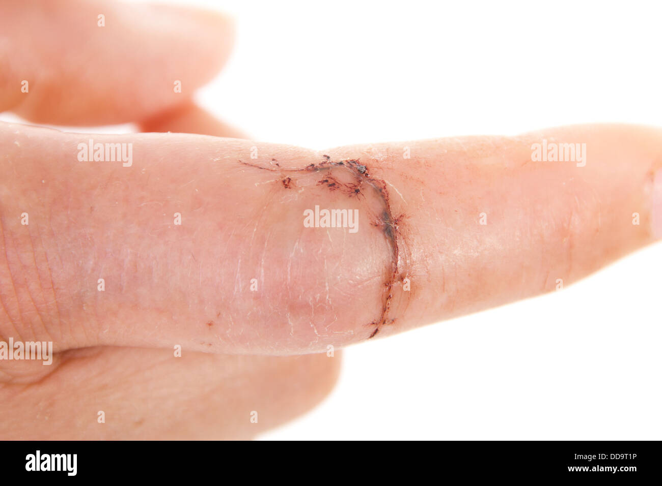 Close-up of sewed wound on caucasian finger Stock Photo