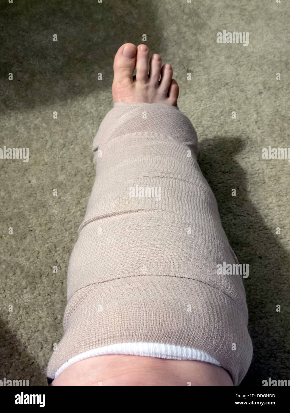 Temporary gauze and ace bandage cast for broken foot. Stock Photo