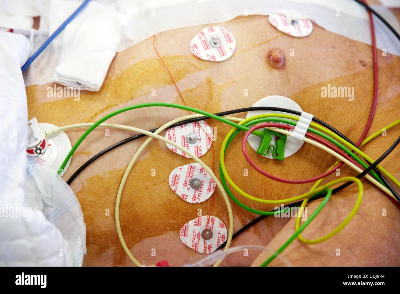Electrodes for monitoring of vital signs, ICU (Intensive Care Unit