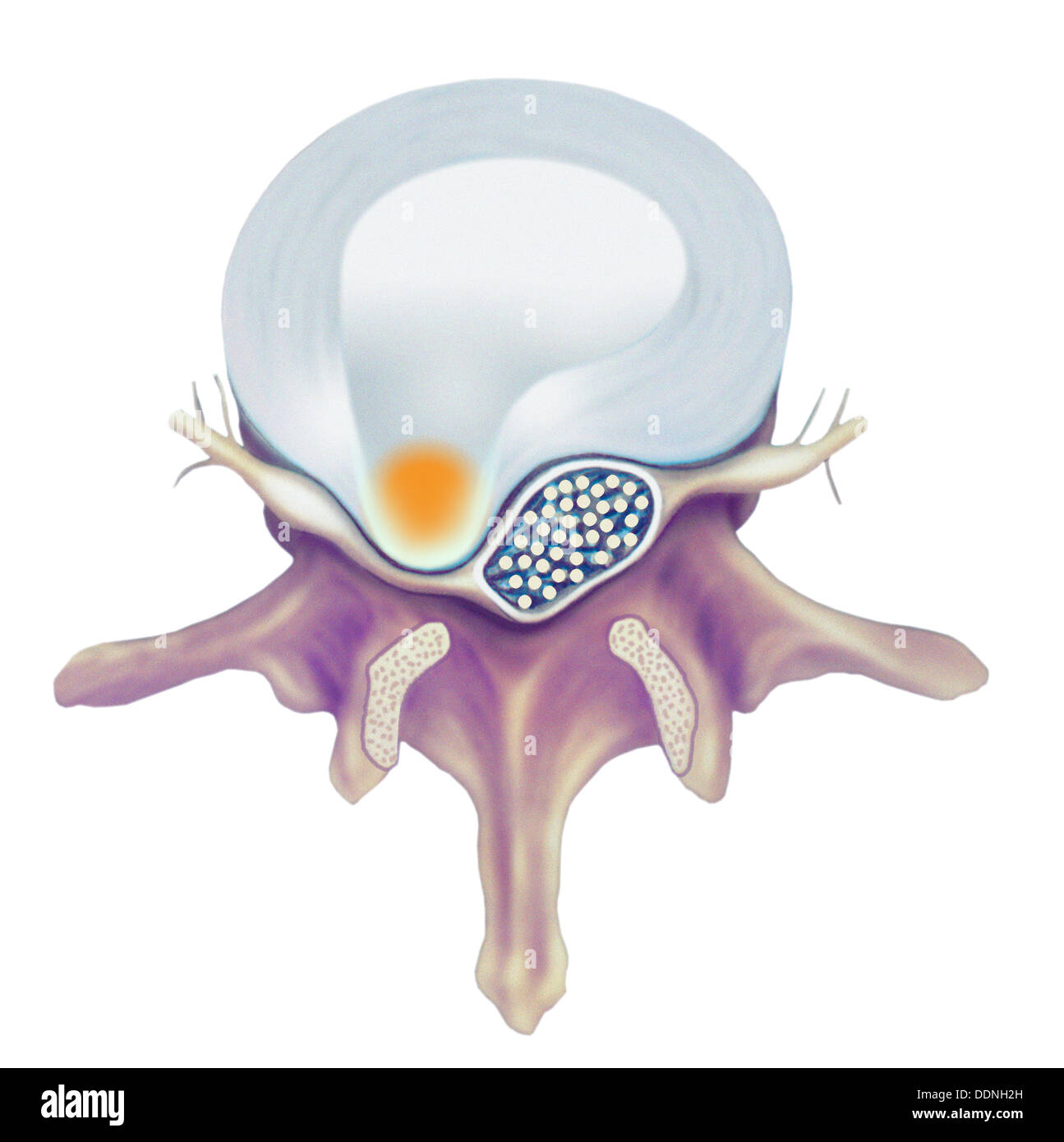 Spinal disc herniation Stock Photo