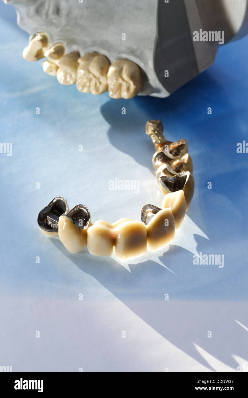 Anterior tooth bridge as ceramic with posterior teeth as inlay-retained bridge and upper jaw model Stock Photo