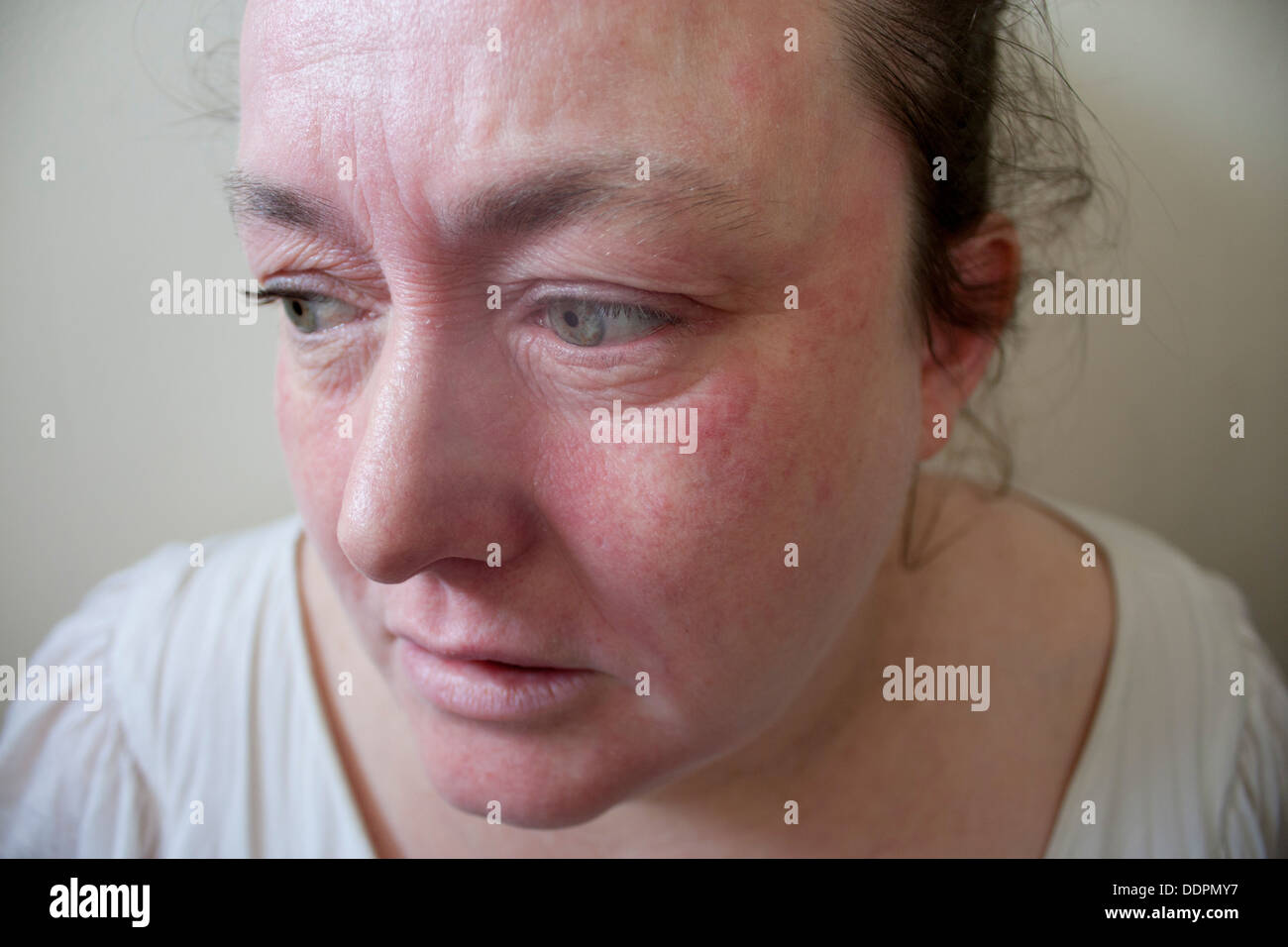 Woman with severe eczema allergic reaction on face Model Released Stock Photo