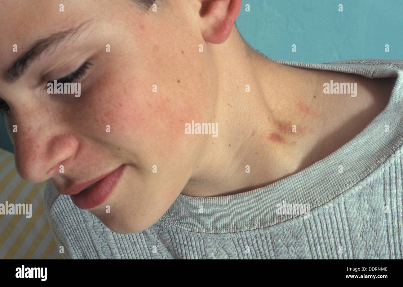 teenage boy with love bite on neck Stock Photo