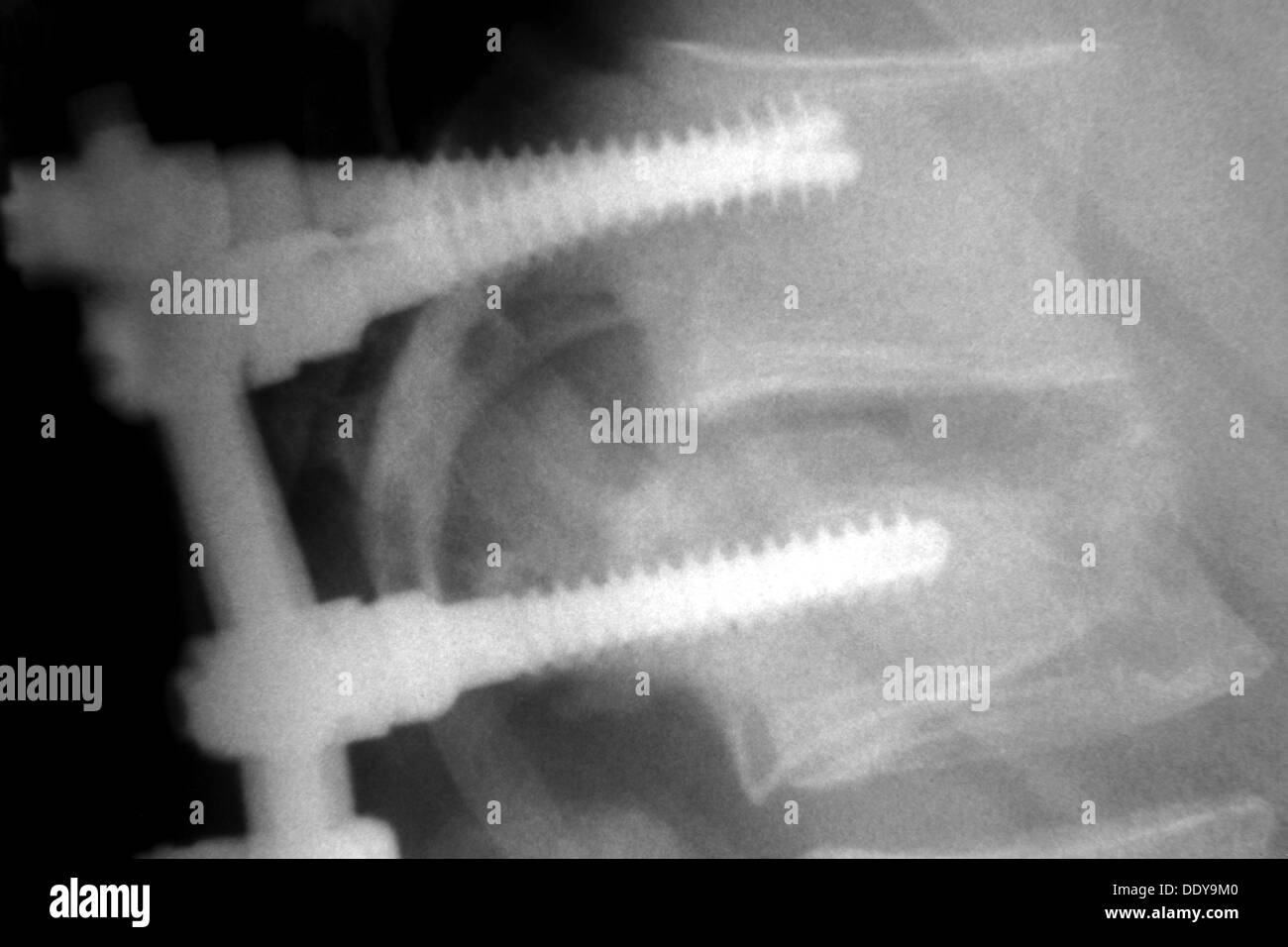 Titanium fixations on spine, compression fractures caused by car