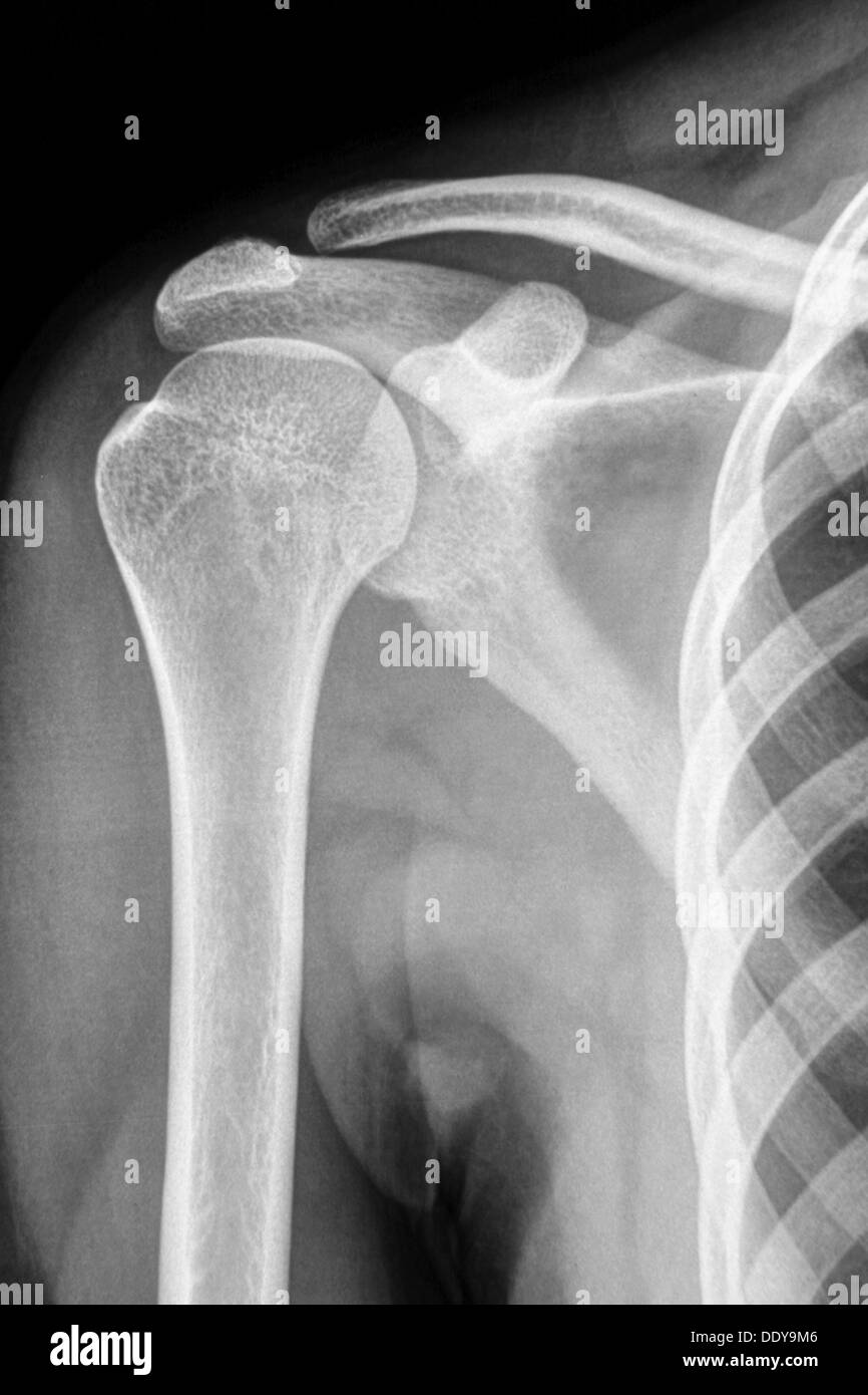 Shoulder bones Xrays Stock Photo Alamy