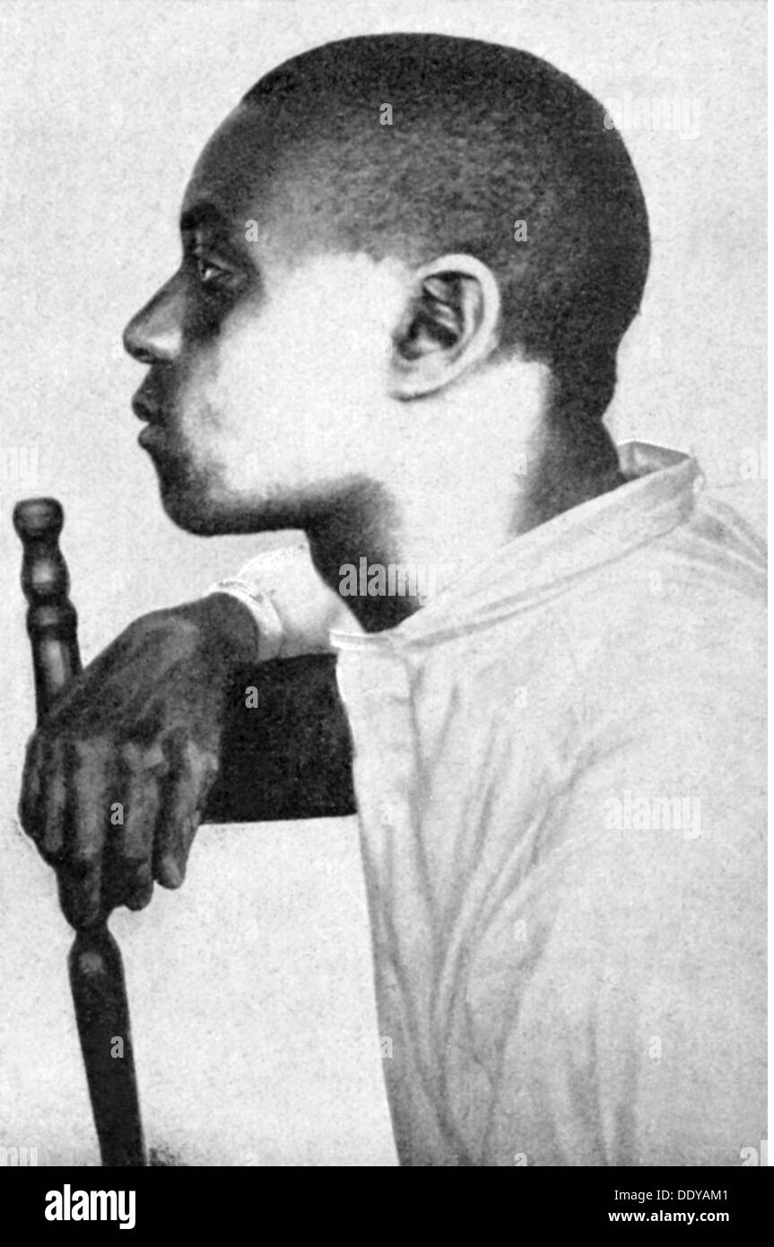 medicine, irradiation / X-ray / measurement, Afro-American after treatment with X-rays to bleach the skin, circa 1910, Additional-Rights-Clearences-Not Available Stock Photo