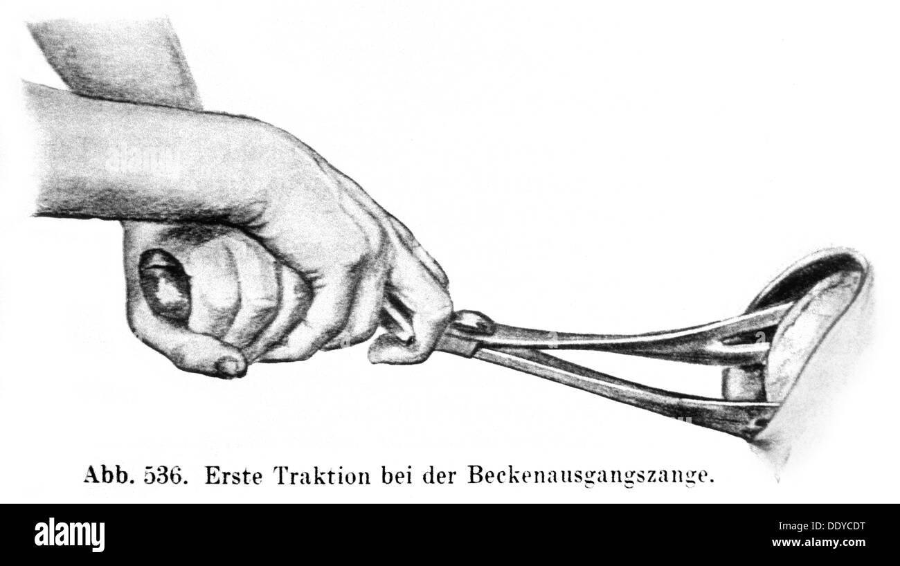 medicine, birth / gynecology, application of a forceps, drawing, 20th century, 20th century, graphic, graphics, obstetrics, device, devices, instrument, instruments, aids and appliances, object, objects, forceps, birthing, bear, give birth, delivery, childbearing, childbirth, traction, tractions, pull, pulling, medicine, medicines, birth, births, gynecology, gynaecology, application, applications, historic, historical, people, Additional-Rights-Clearences-Not Available Stock Photo