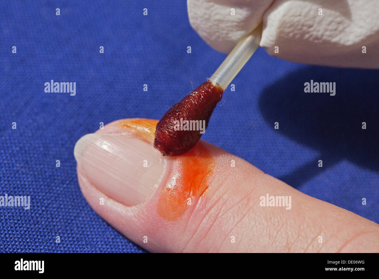 Bacterial infection, inflammation, index finger, disinfecting a wound Stock Photo