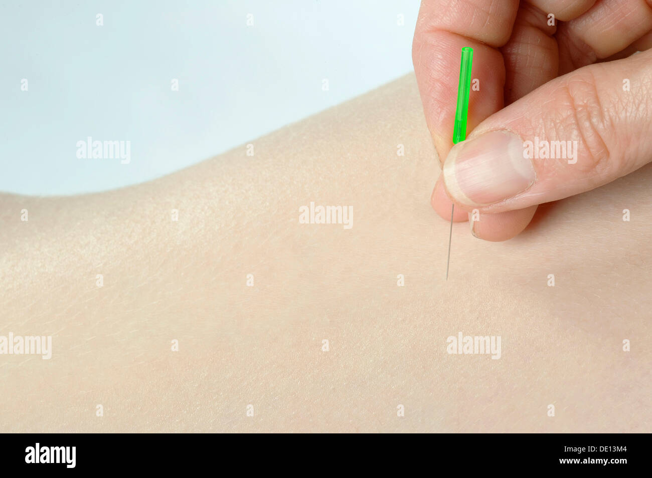 Acupuncture, medical treatment, acupuncture needle Stock Photo