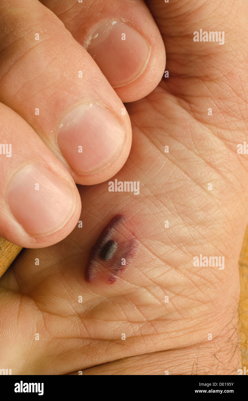 Friction Blister High Resolution Stock Photography And Images Alamy