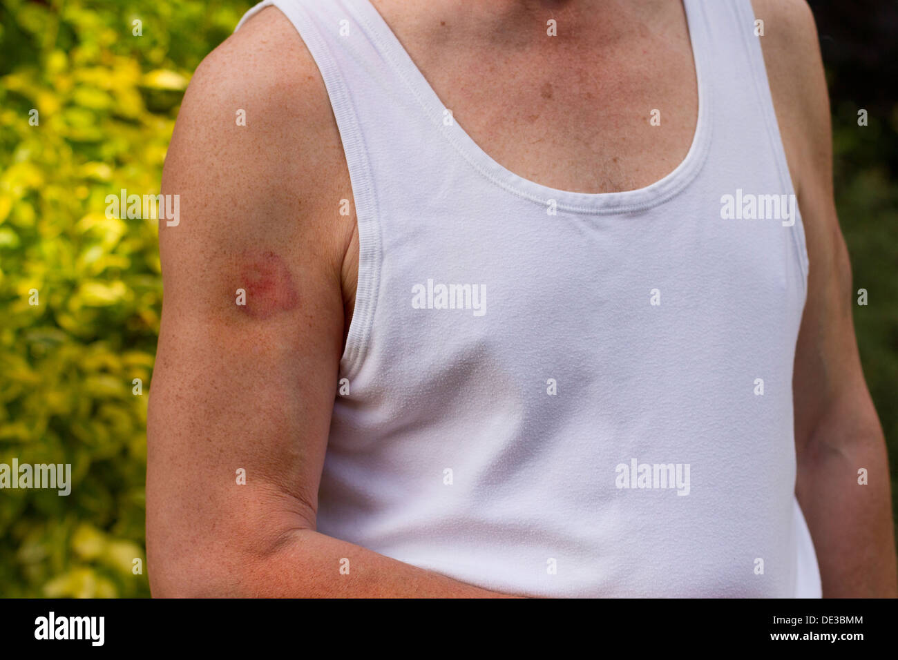 Hematoma Stock Photos Hematoma Stock Images Alamy pin-on-chiropractic-alternative-health