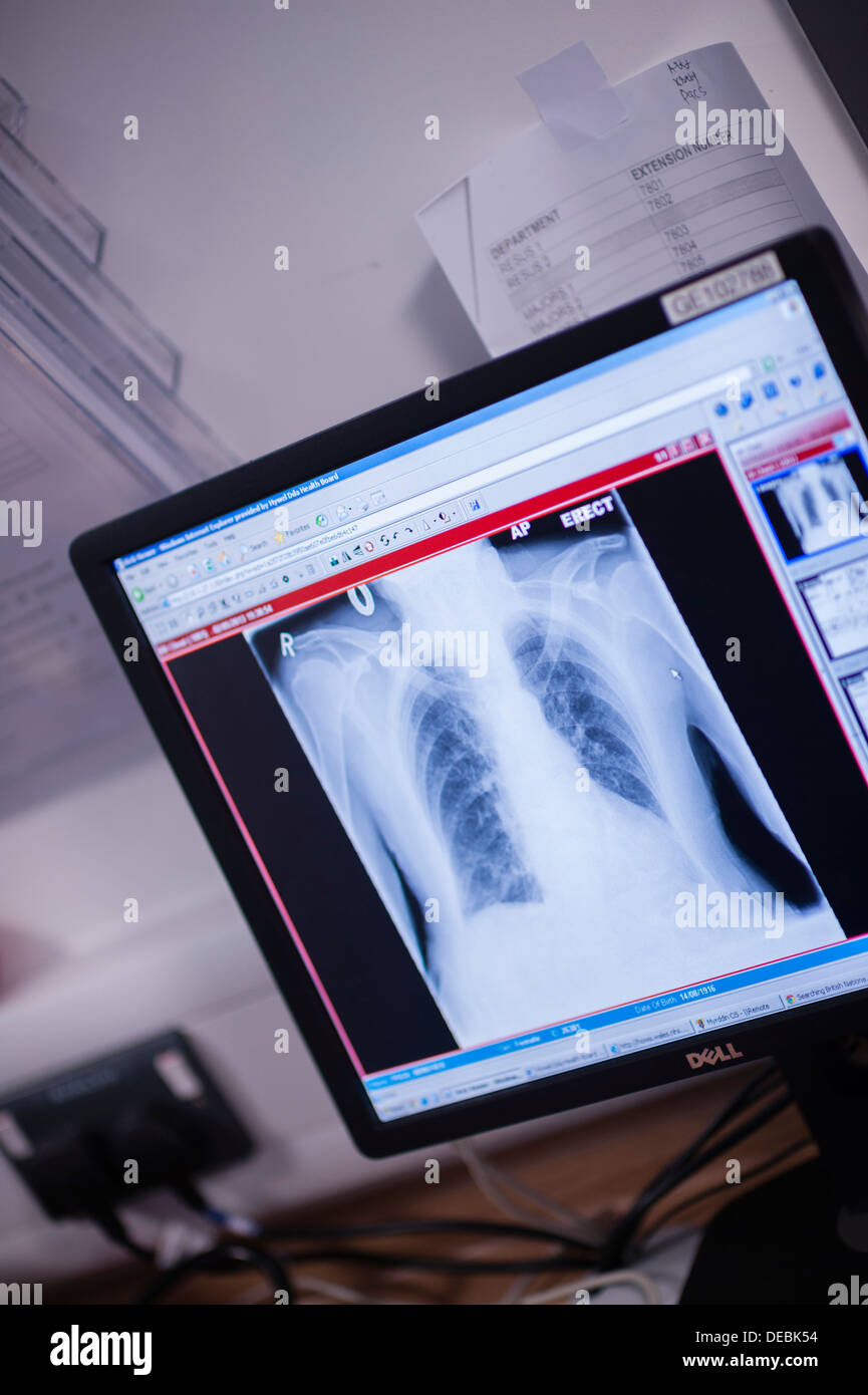 A chest xray on a computer screen in the Accident and Emergency