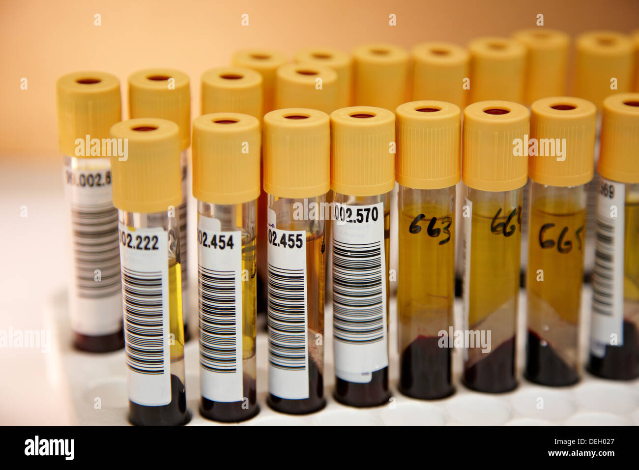 Blood samples, DNA and RNA biobank, extraction and storage of DNA/RNA