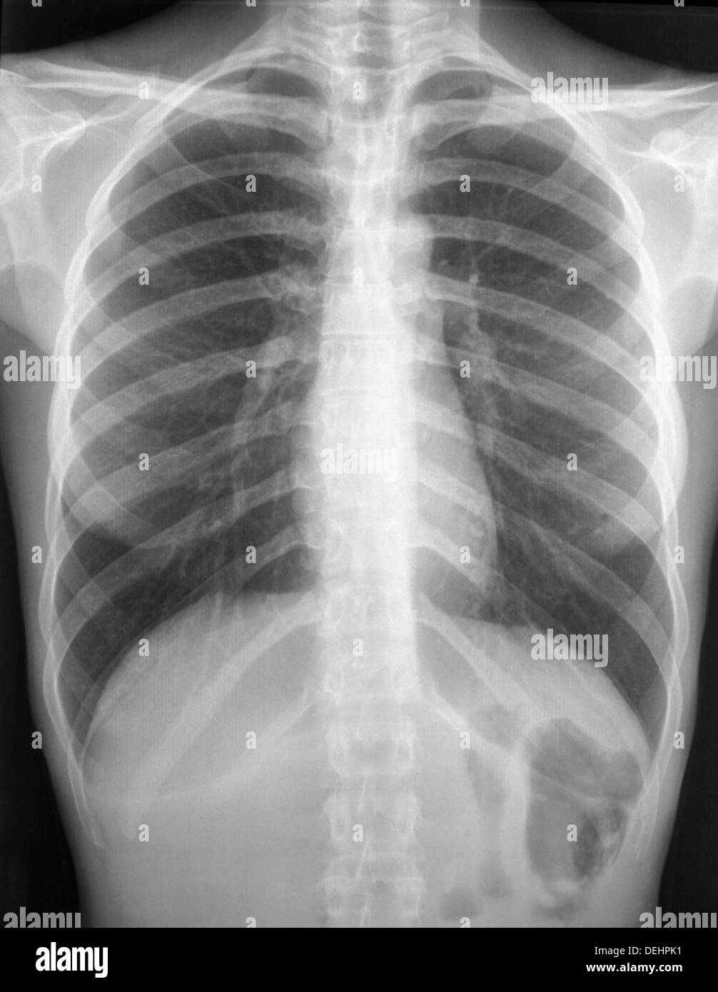 X ray x ray Black and White Stock Photos & Images Alamy