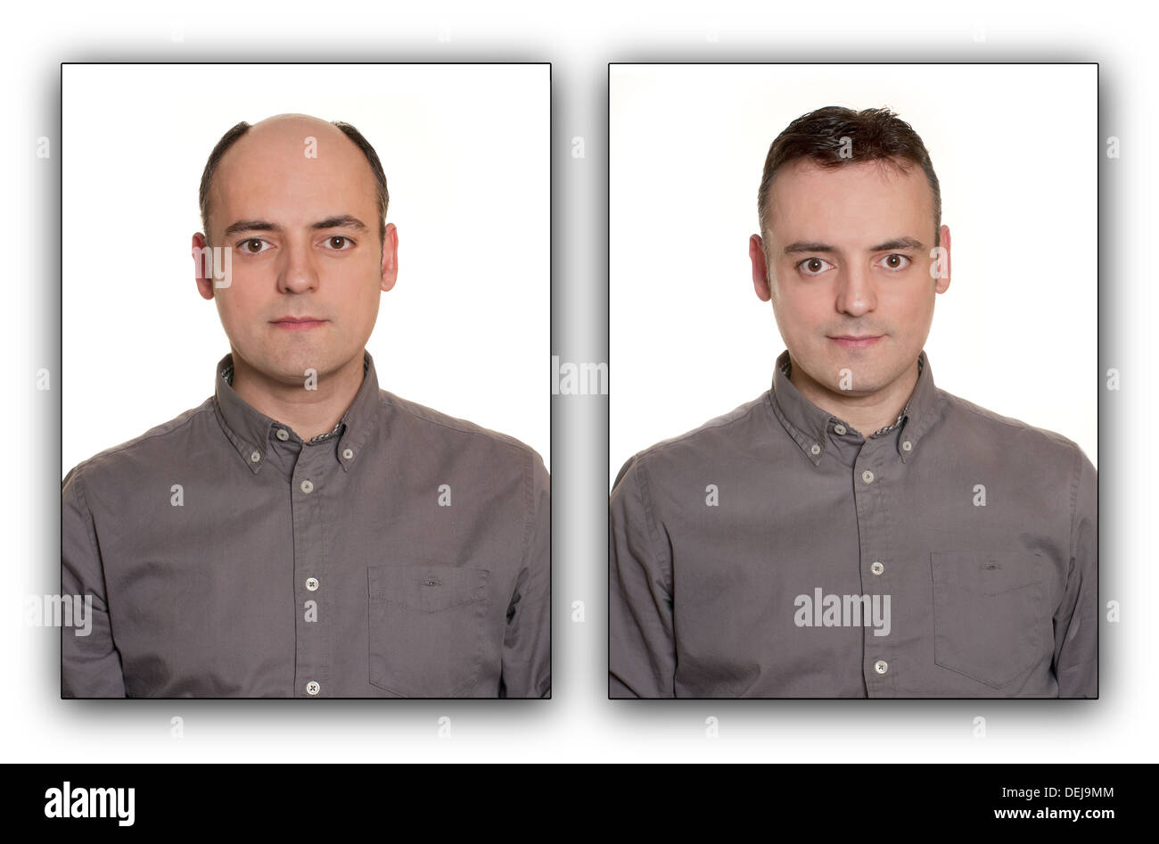 Bald man with a Wig. Before & After Concept. Stock Photo