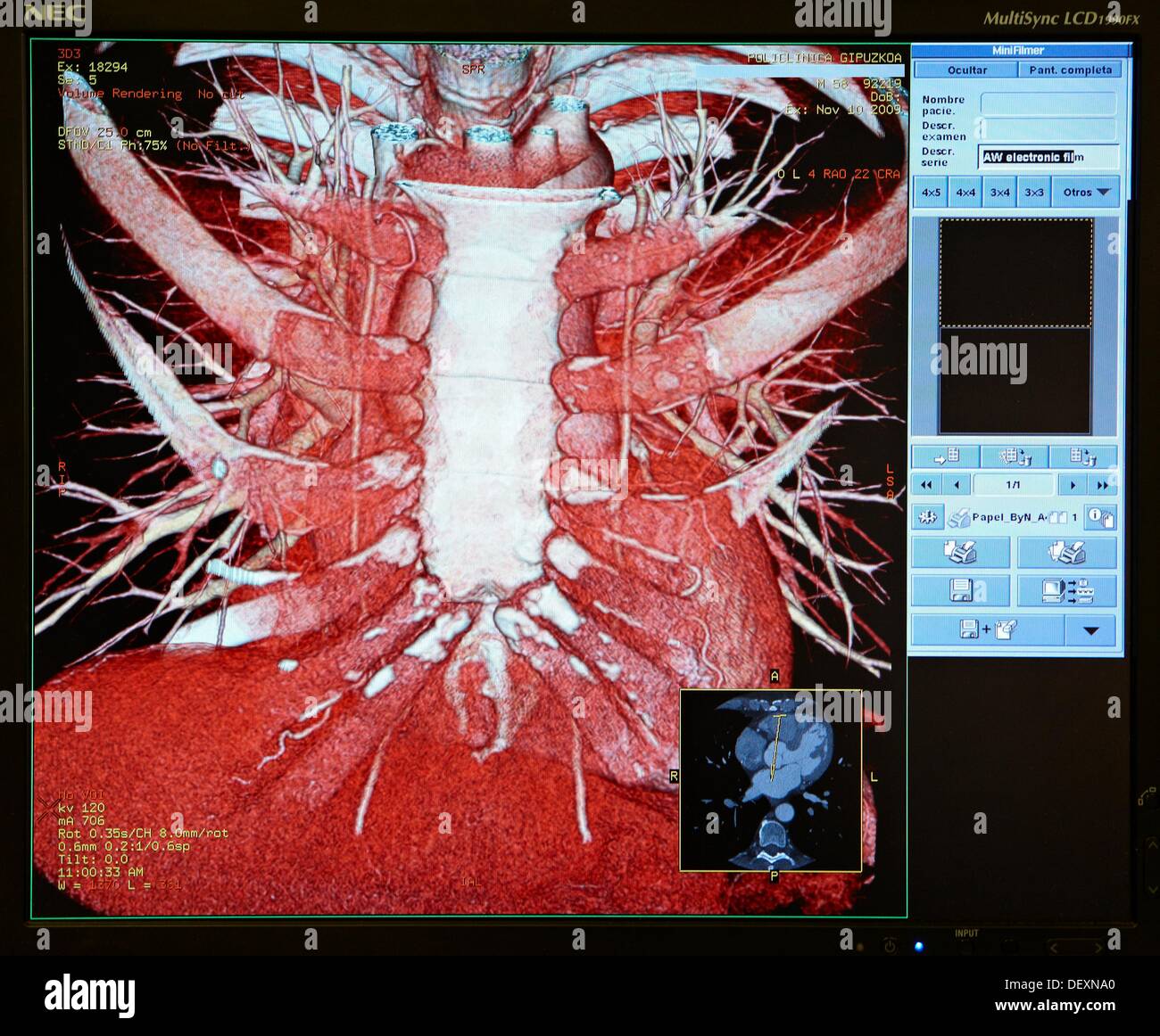 HD(highdefinition) scan of heart, CAT, medical imaging for diagnosis. Hospital Policlinica