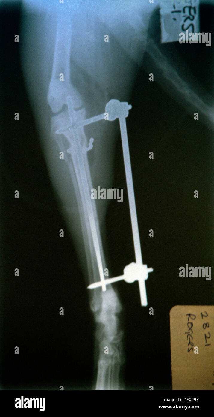 Leg x ray hires stock photography and images Alamy
