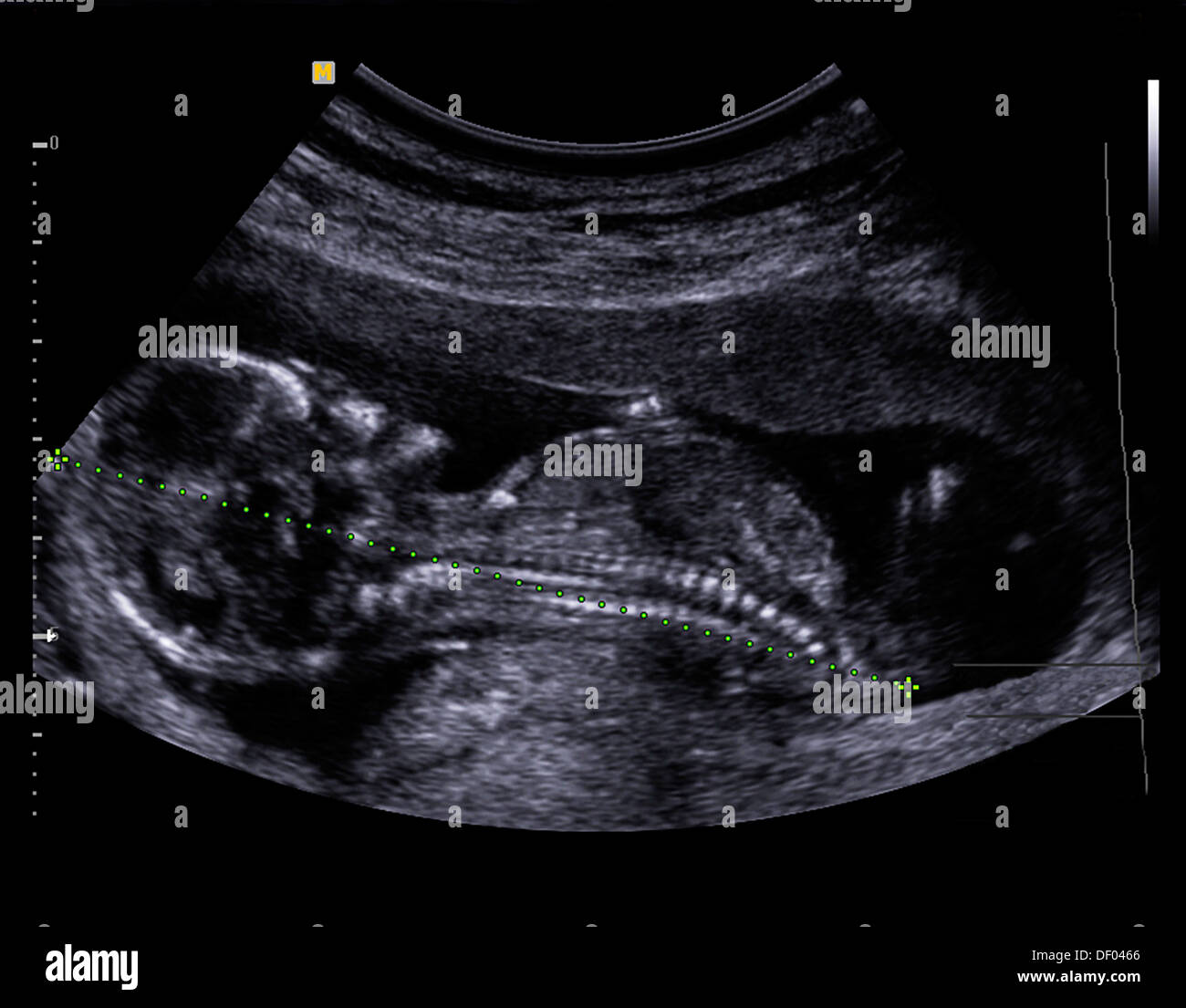 Ultrasound Of Baby At Five Month Stock Photo Alamy