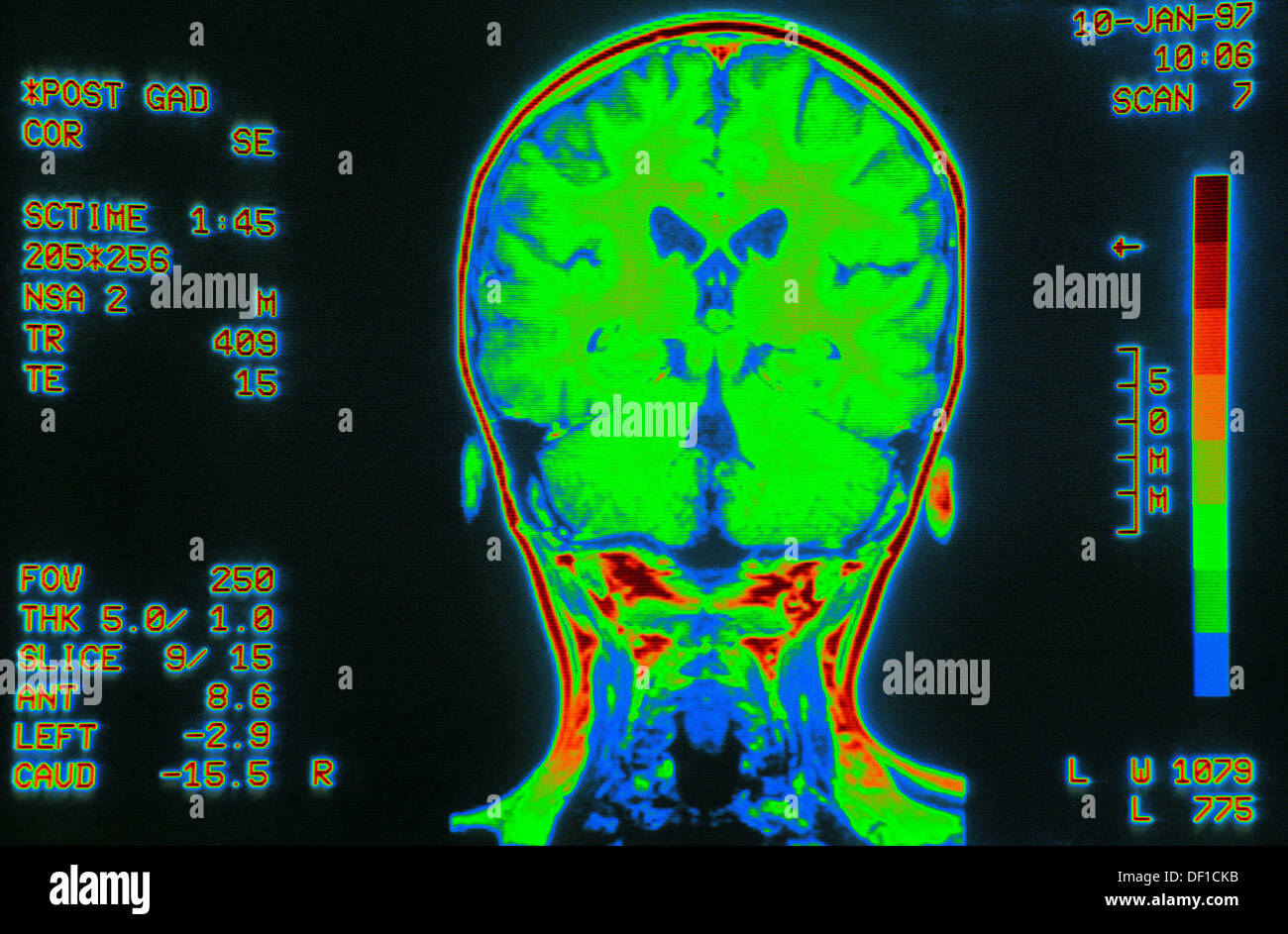 Coloured MRI brain scan, back view Stock Photo 60882847 Alamy