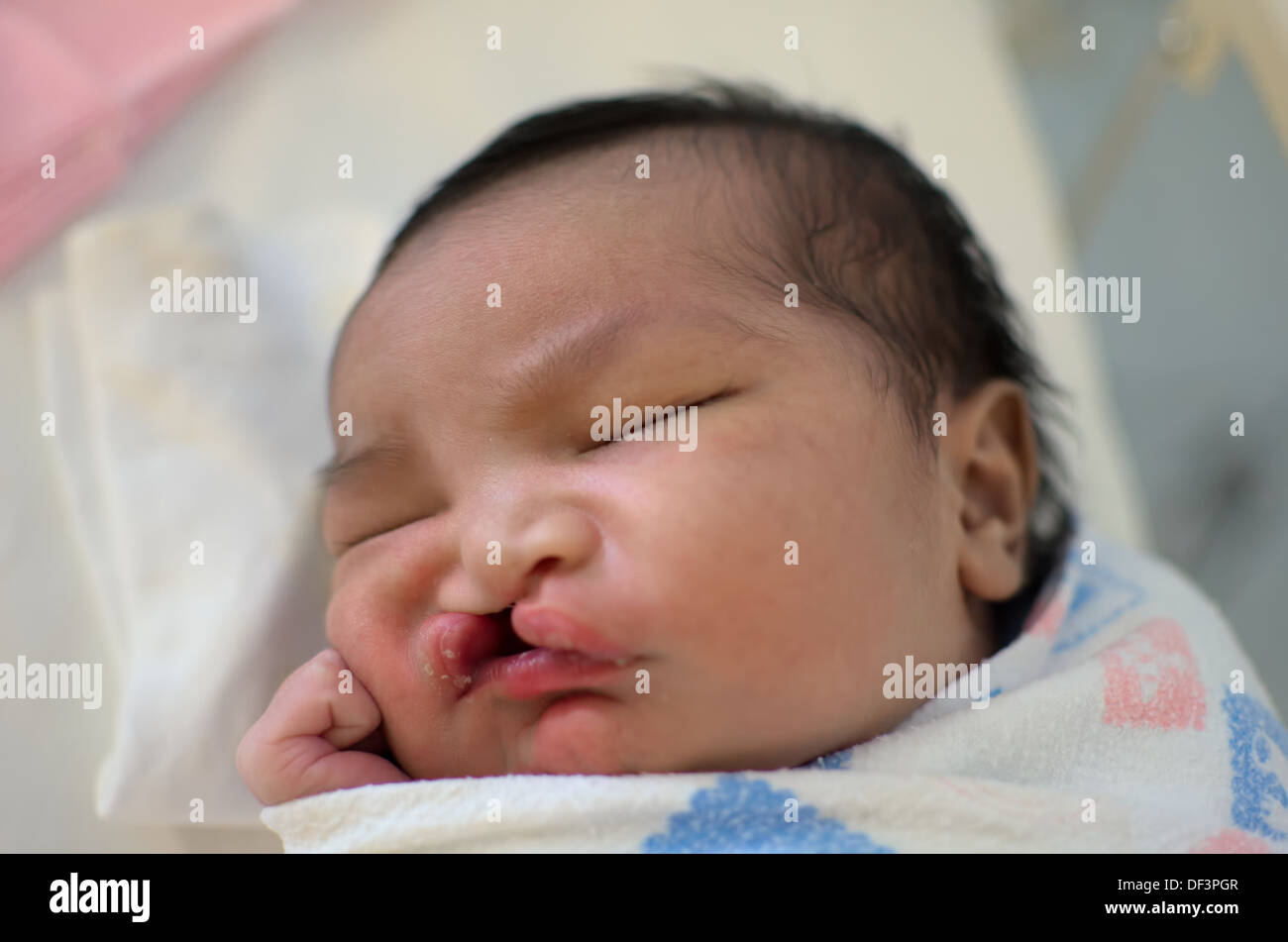 Newborn baby with cleft lip and palate sleeping. Stock Photo