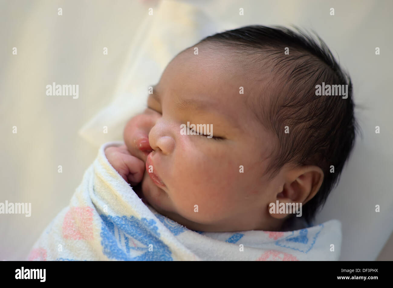 Newborn baby with cleft lip and palate sleeping. Stock Photo