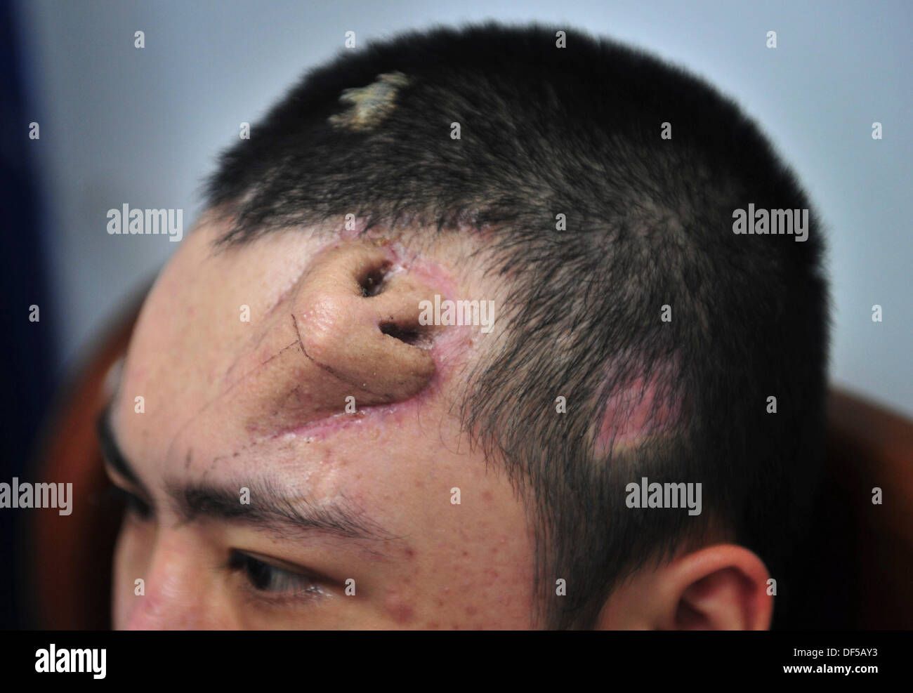Un paciente de 22 años con una nariz injertada en la frente y que fue creada por médicos a partir de cartílago de su costilla, el 24 de septiembre de 2013 en el Hospital Unión de la Universidad Médica Fujian, en Fuzhou, China. Los médicos crearon la nariz extra para un trasplante, el primero en su tipo. (Foto AP)  CHINA OUT Stock Photo