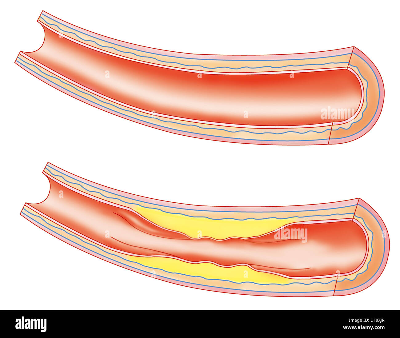 ATHEROMA, DRAWING Stock Photo - Alamy