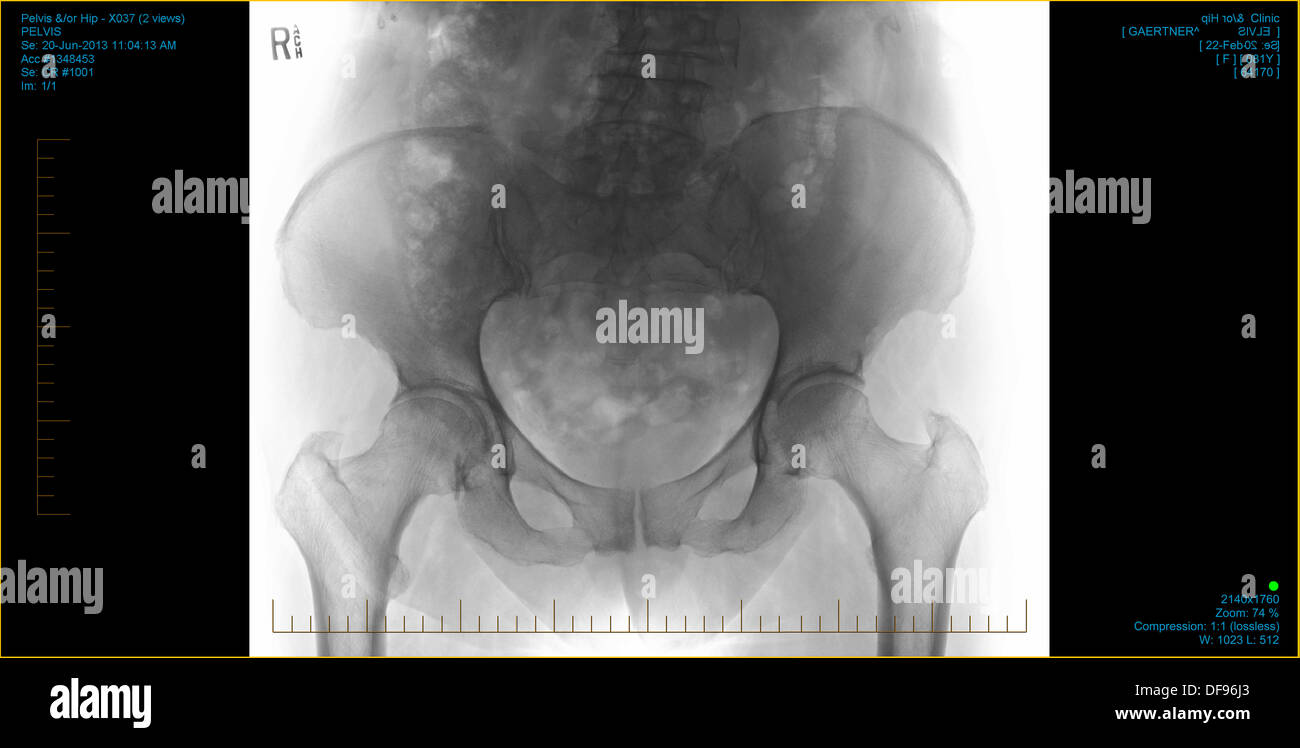 Positive Computer Diagnostic Medical X Ray Scan Of A Hip Showing Joints