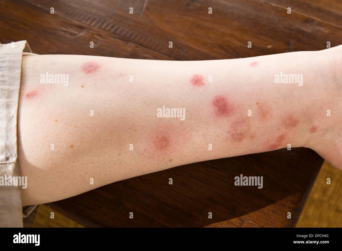 Covered in mosquito bites hires stock photography and images Alamy