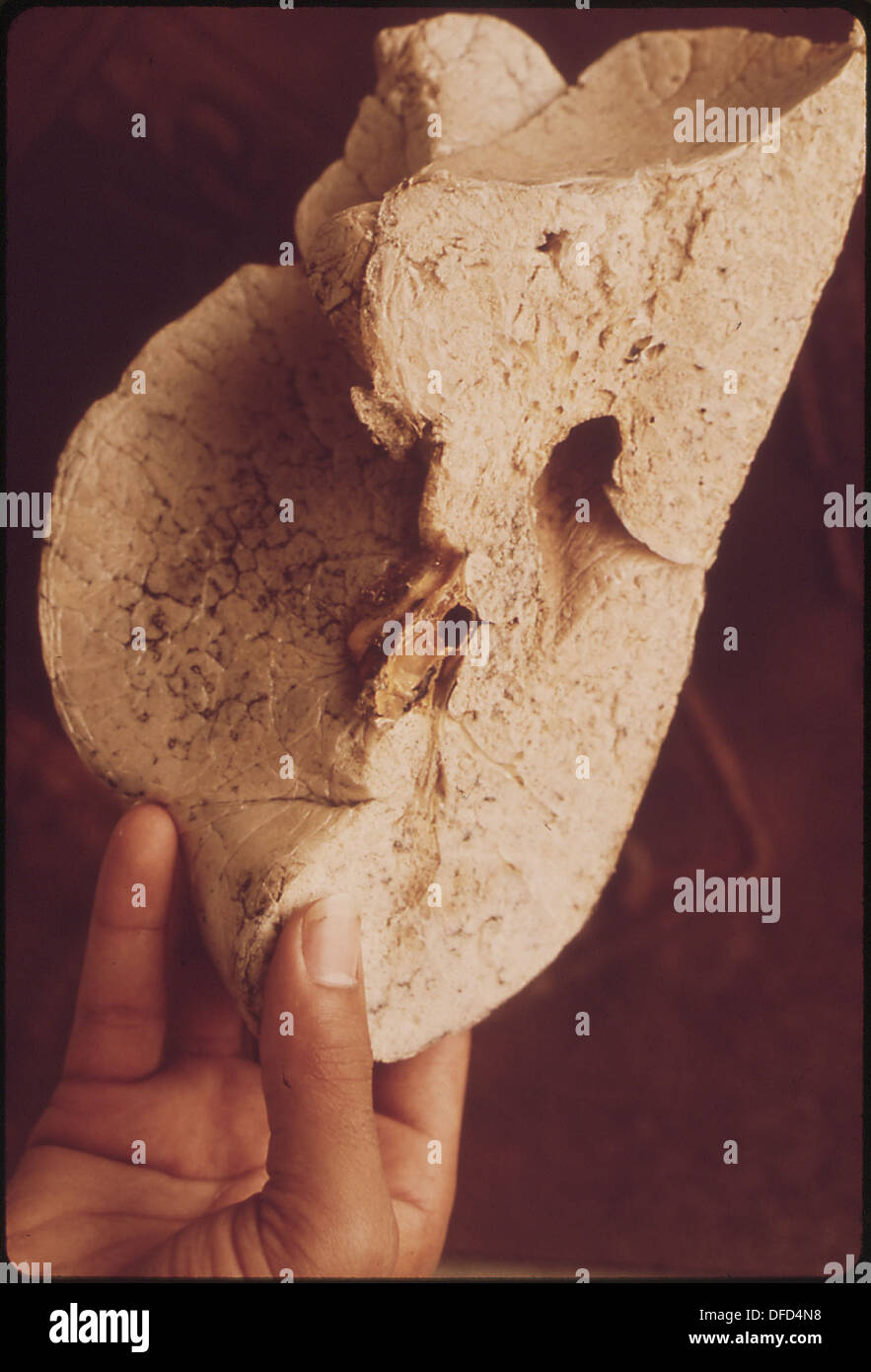 ENLARGED LUNG OF EMPHYSEMA VICTIM. SEVERE AIR POLLUTION INCREASES RISK