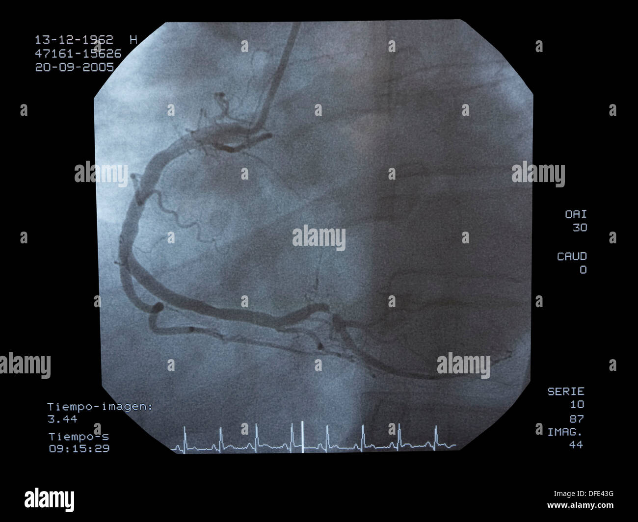Angiography, implantation of ICD (Automatic Implantable Cardioverter