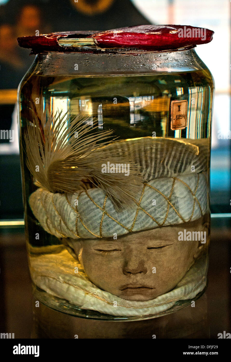 Childs's head with Turkish Cap 1705 Anatomical Museum Bleulandinum  Dutch Netherlands Stock Photo