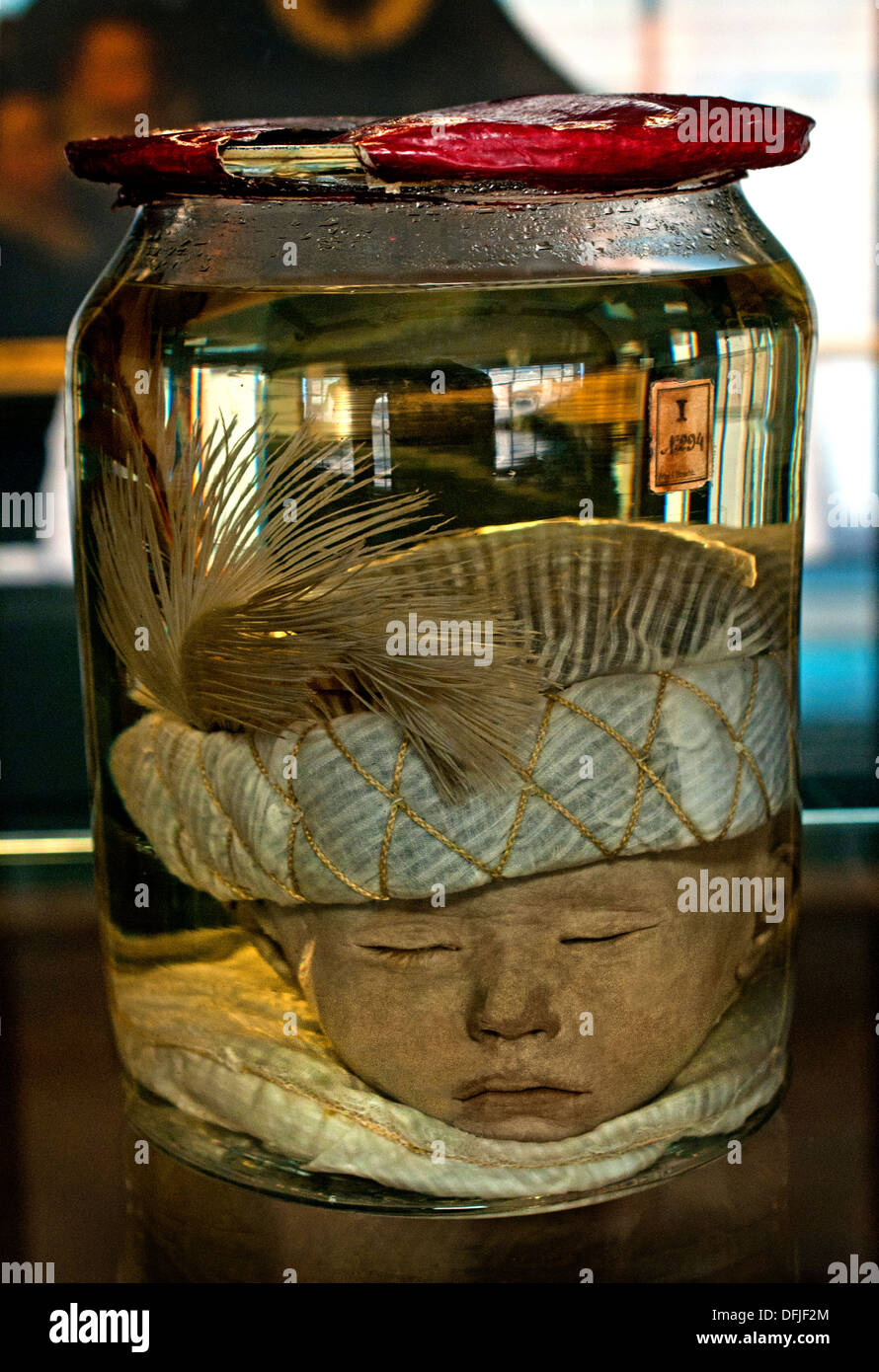 Childs's head with Turkish Cap 1705 Anatomical Museum Bleulandinum  Dutch Netherlands Stock Photo