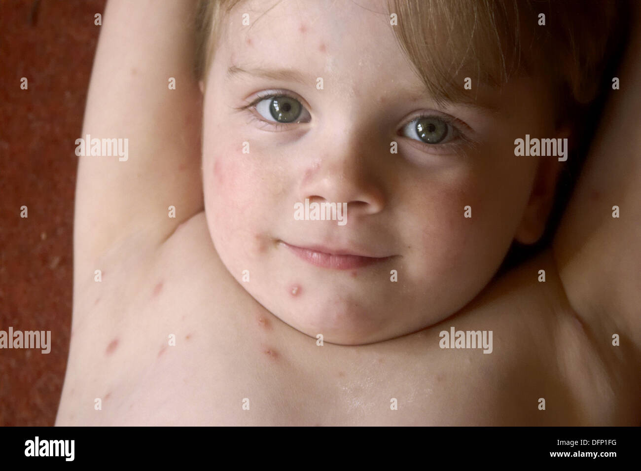 Child With Chicken Pox Spots On Face And Calamine Lotion, 40% OFF