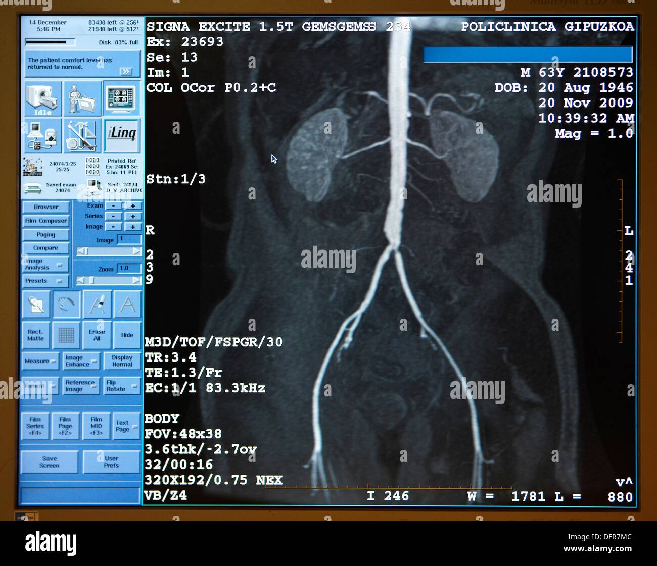 Kidneys, aorta, renal and iliac arteries, MRI Resonance