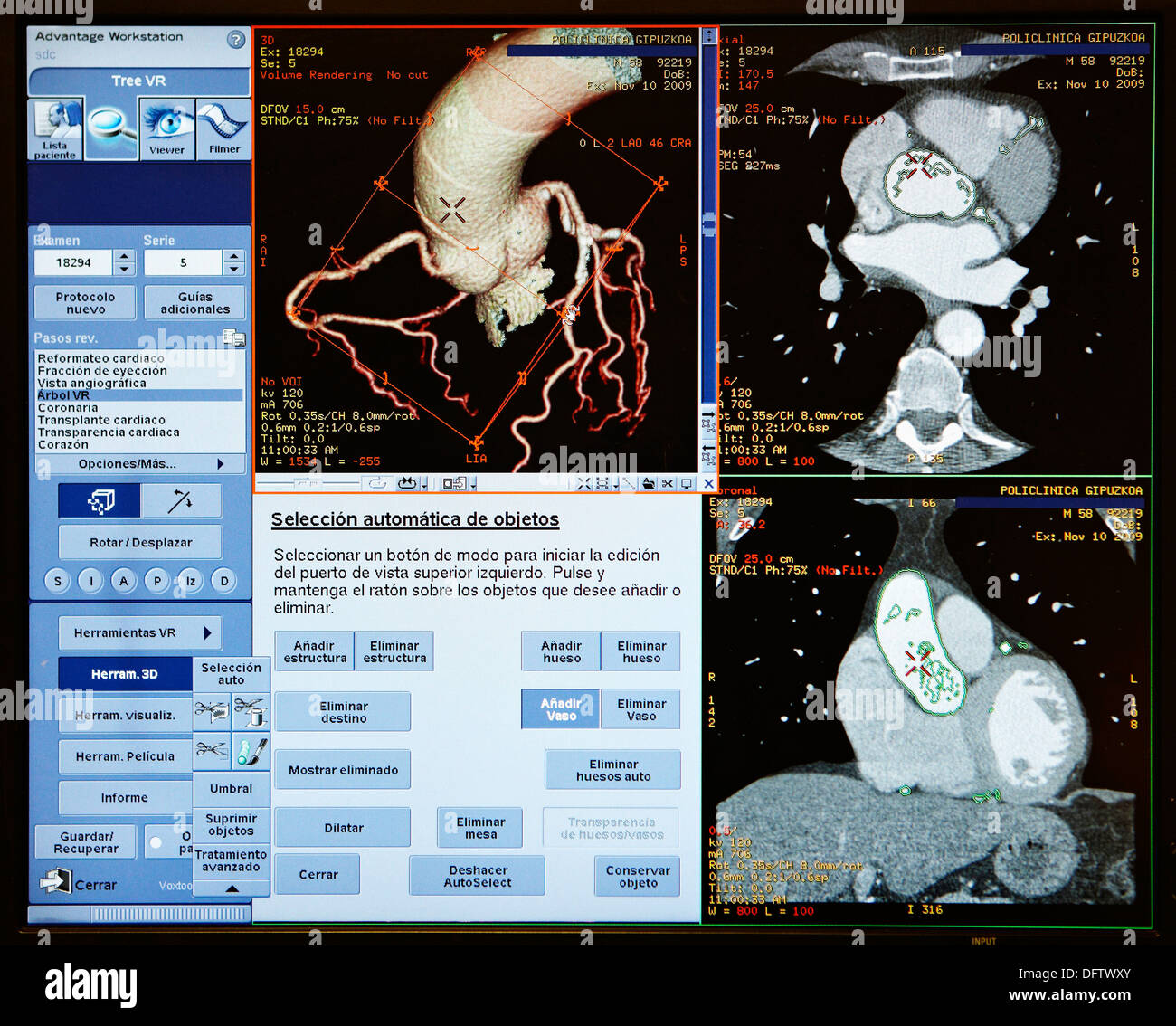 HD(highdefinition) scan of heart, CAT, medical imaging for diagnosis. Hospital Policlinica