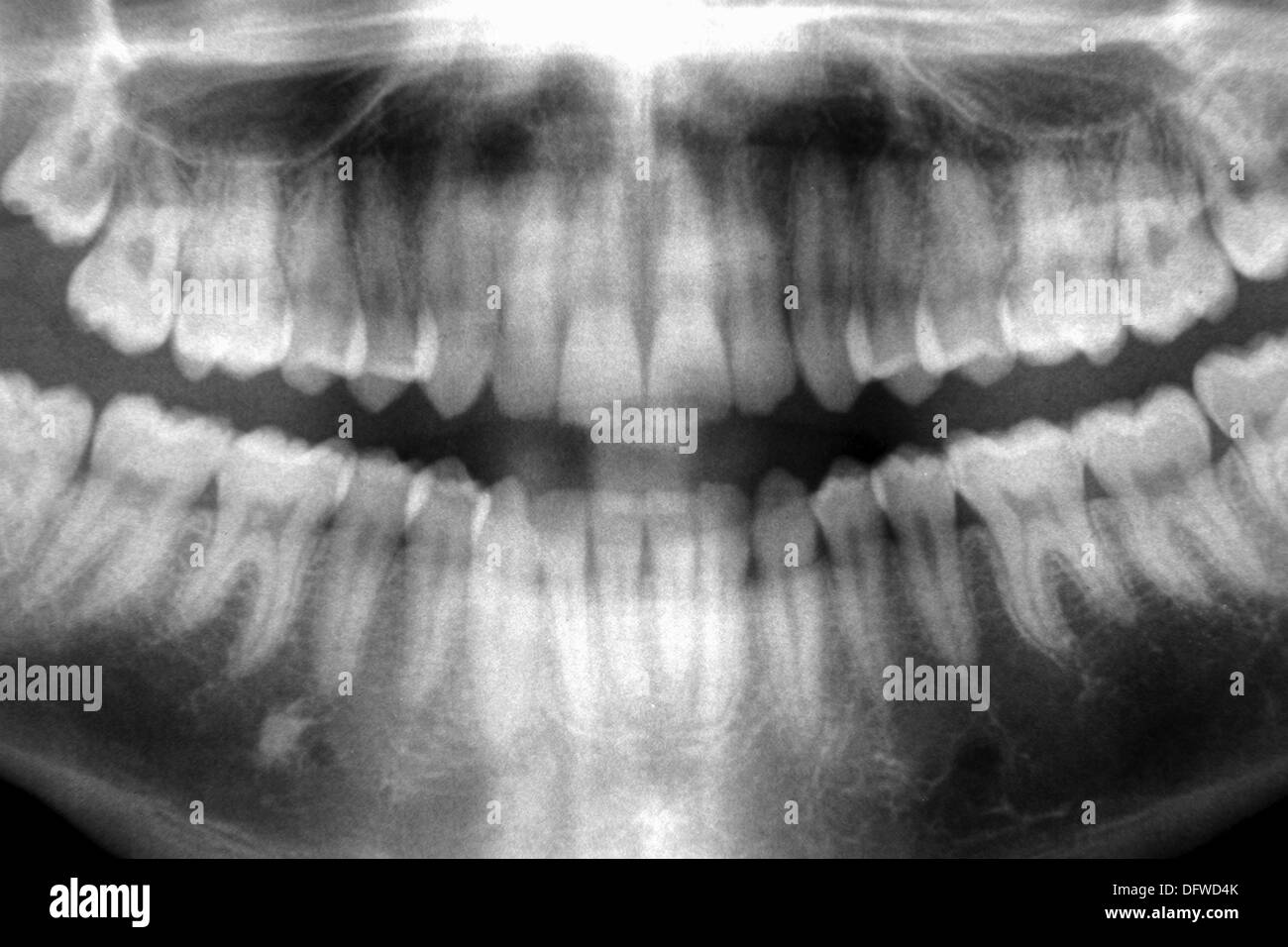 Tooth x ray Black and White Stock Photos & Images Alamy