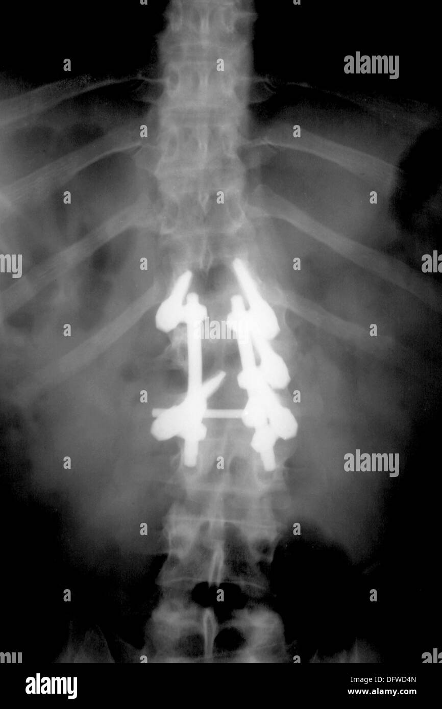 Titanium fixations on spine, compression fractures caused by car