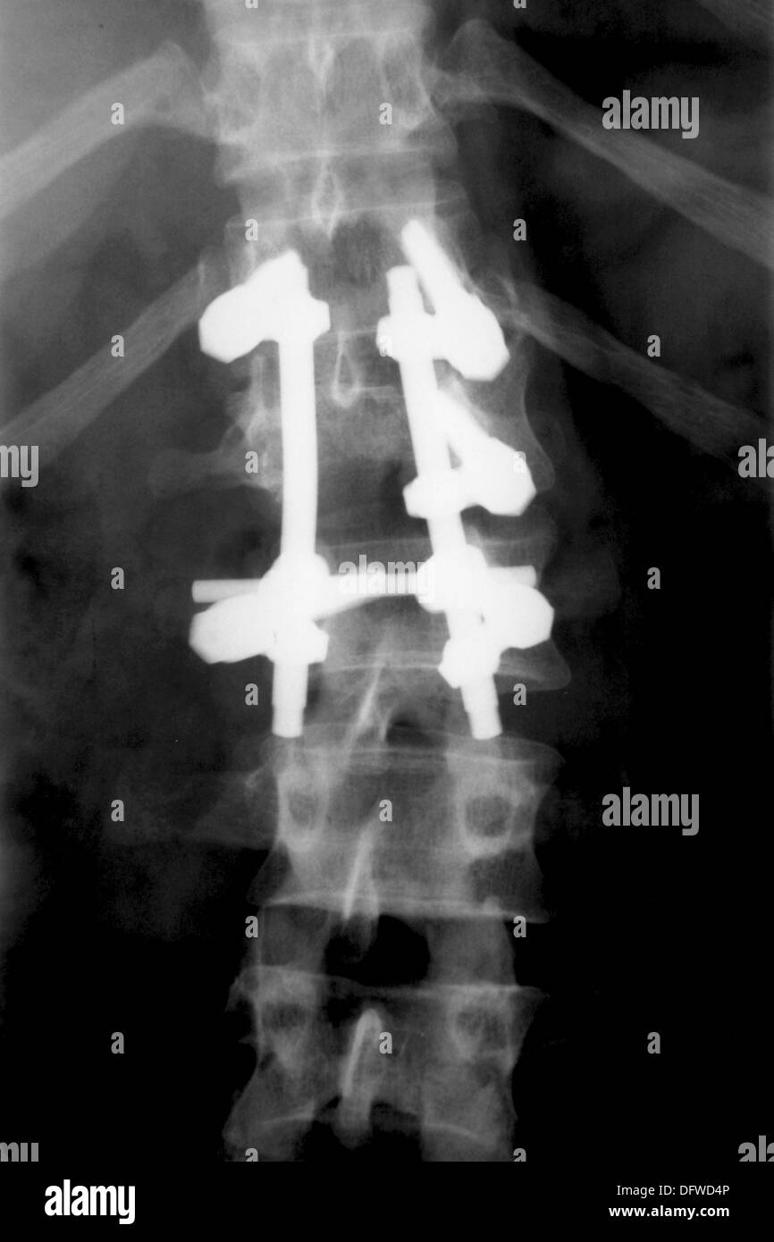 Titanium fixations on spine, compression fractures caused by car