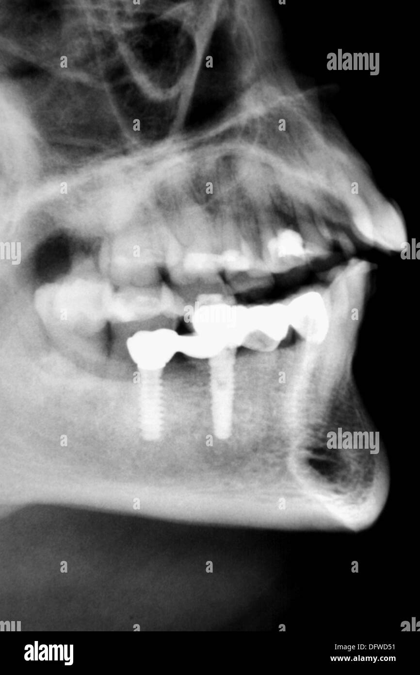 Titanium x ray hires stock photography and images Alamy