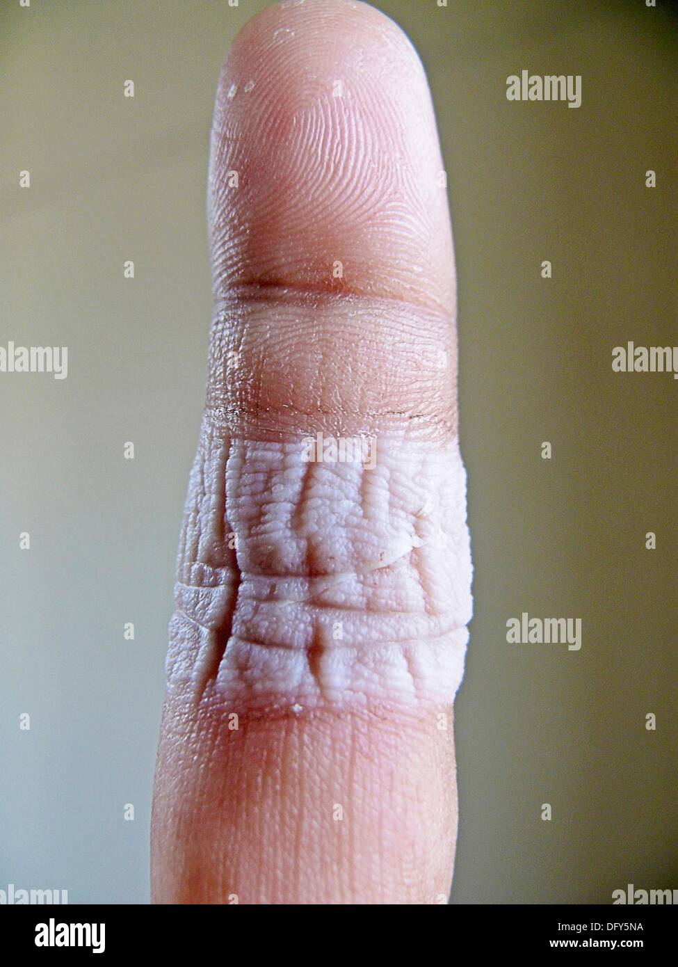 human finger after removing band aid stock photo 61448166 alamy