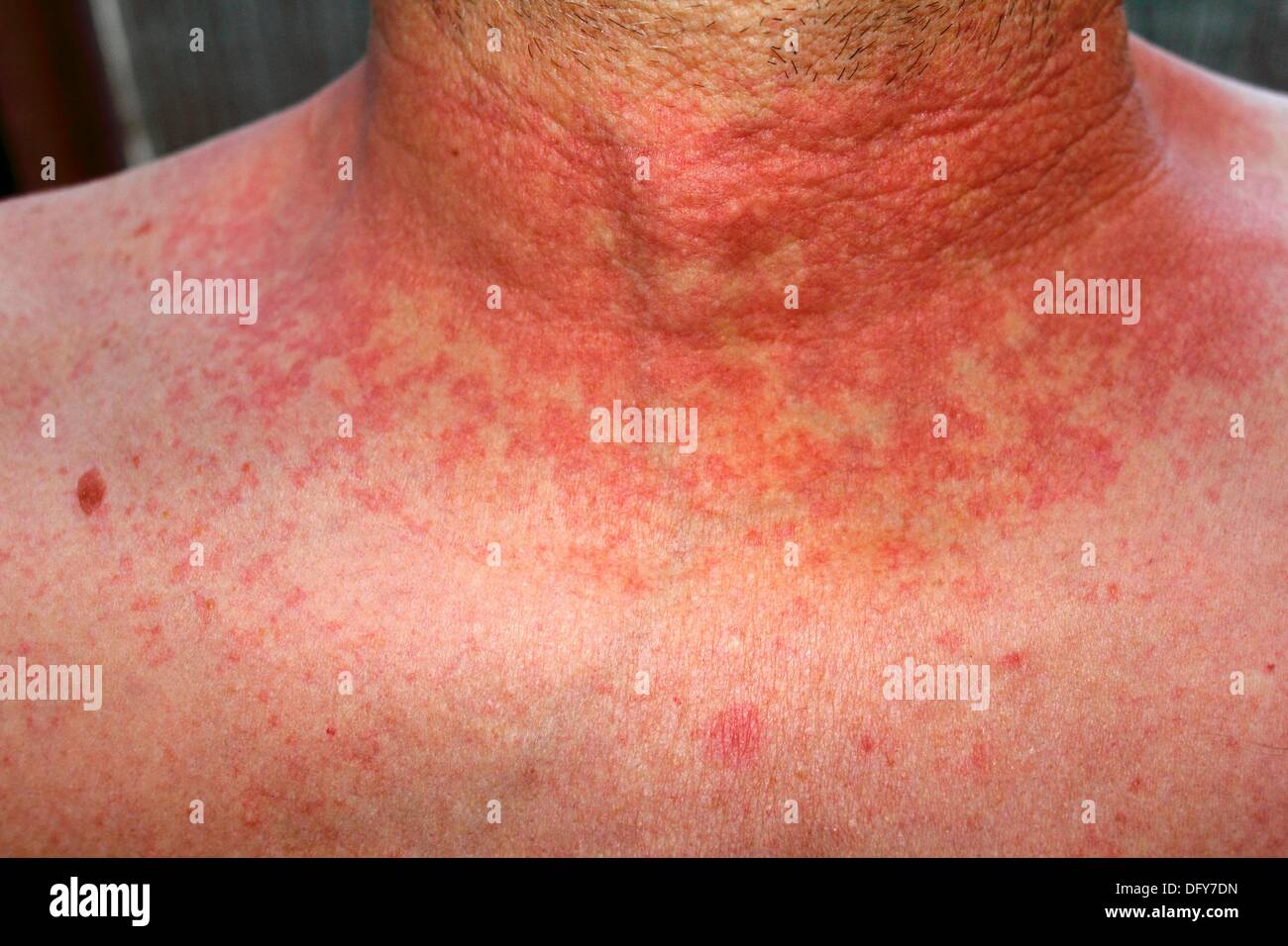 Scarlet fever mouth with symptoms of scarlatina Vector Image