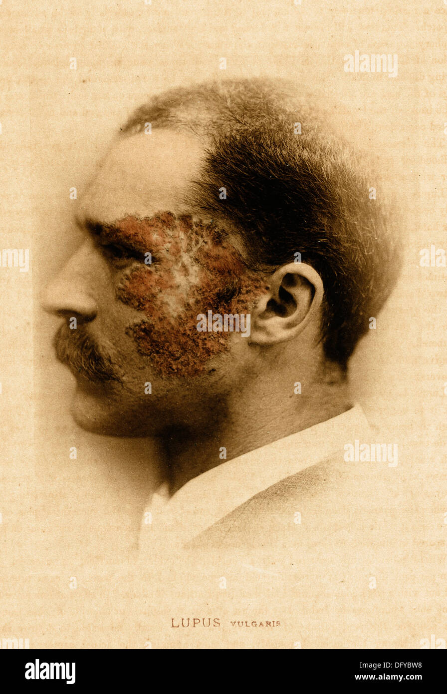 Lupus, ca 1881, by E. Bierstadt Stock Photo