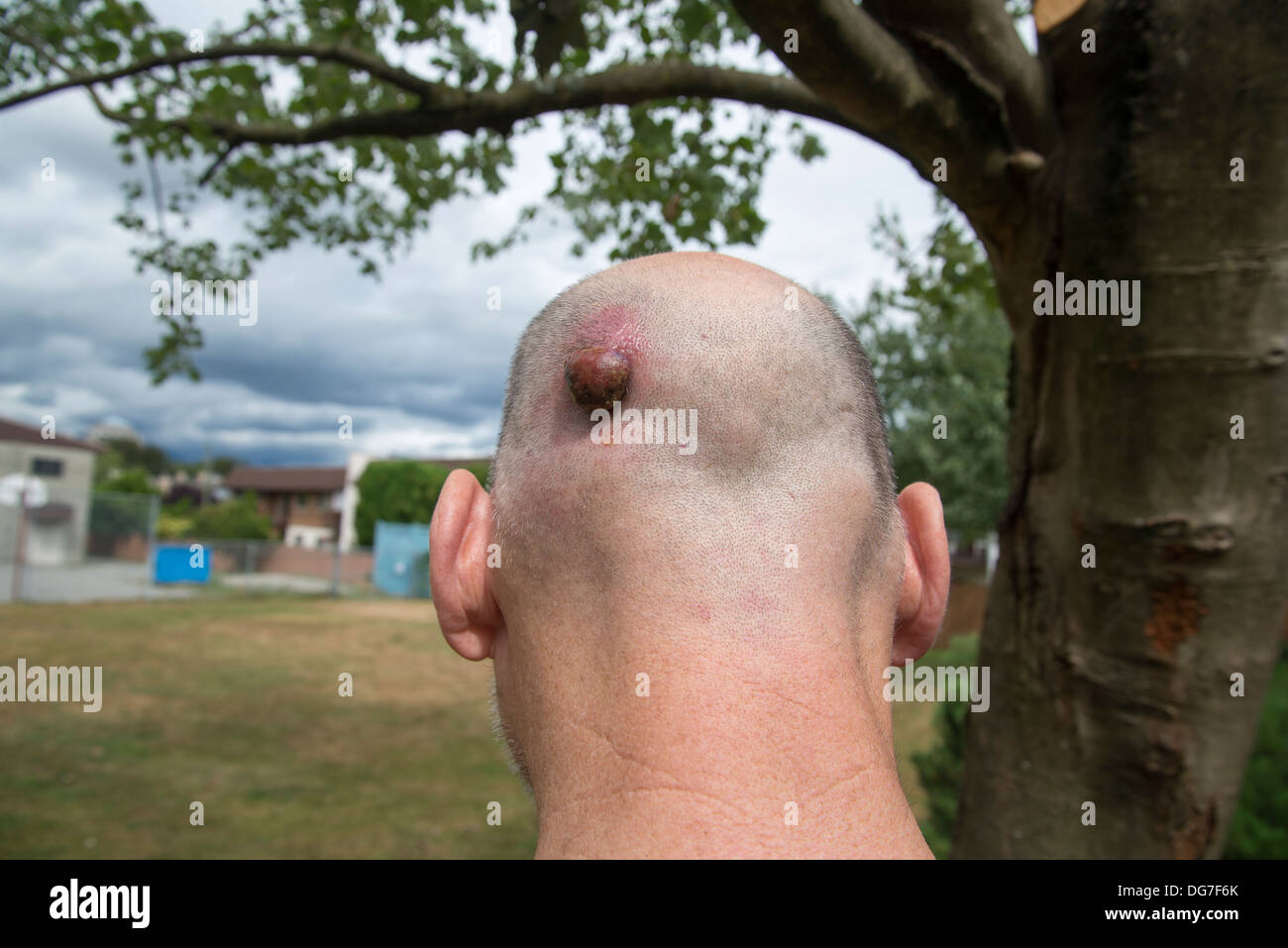 Pyogenic granuloma skin growth on mans head Stock Photo