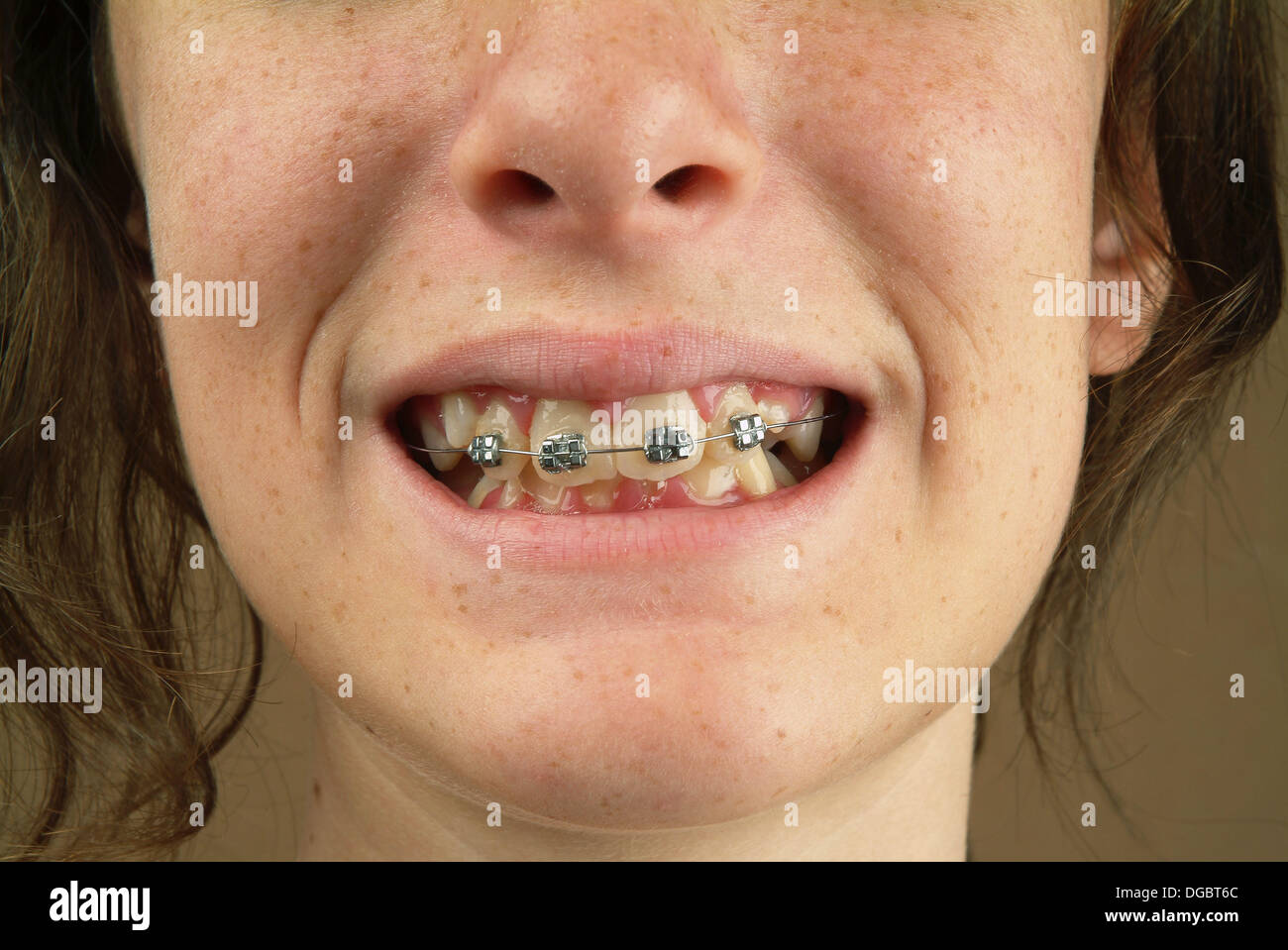 Close the mouth with braces of a teenage girl Stock Photo 61726068 Alamy